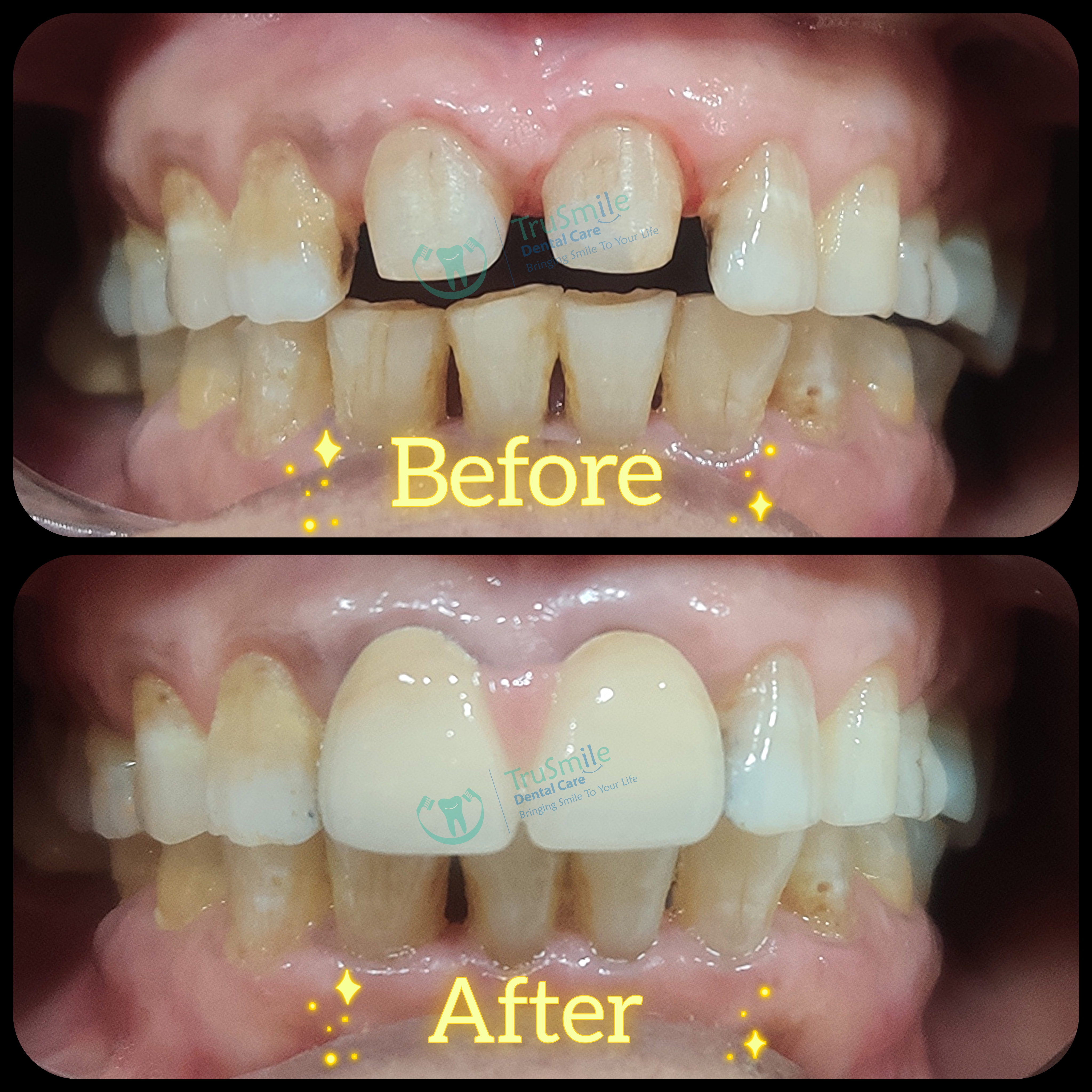 Zirconia 9